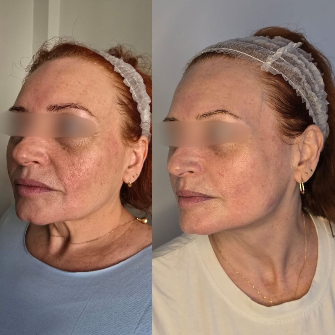 Neurolifting przed i po — ujęcie skośne, promienna i zagęszczona cera na czole