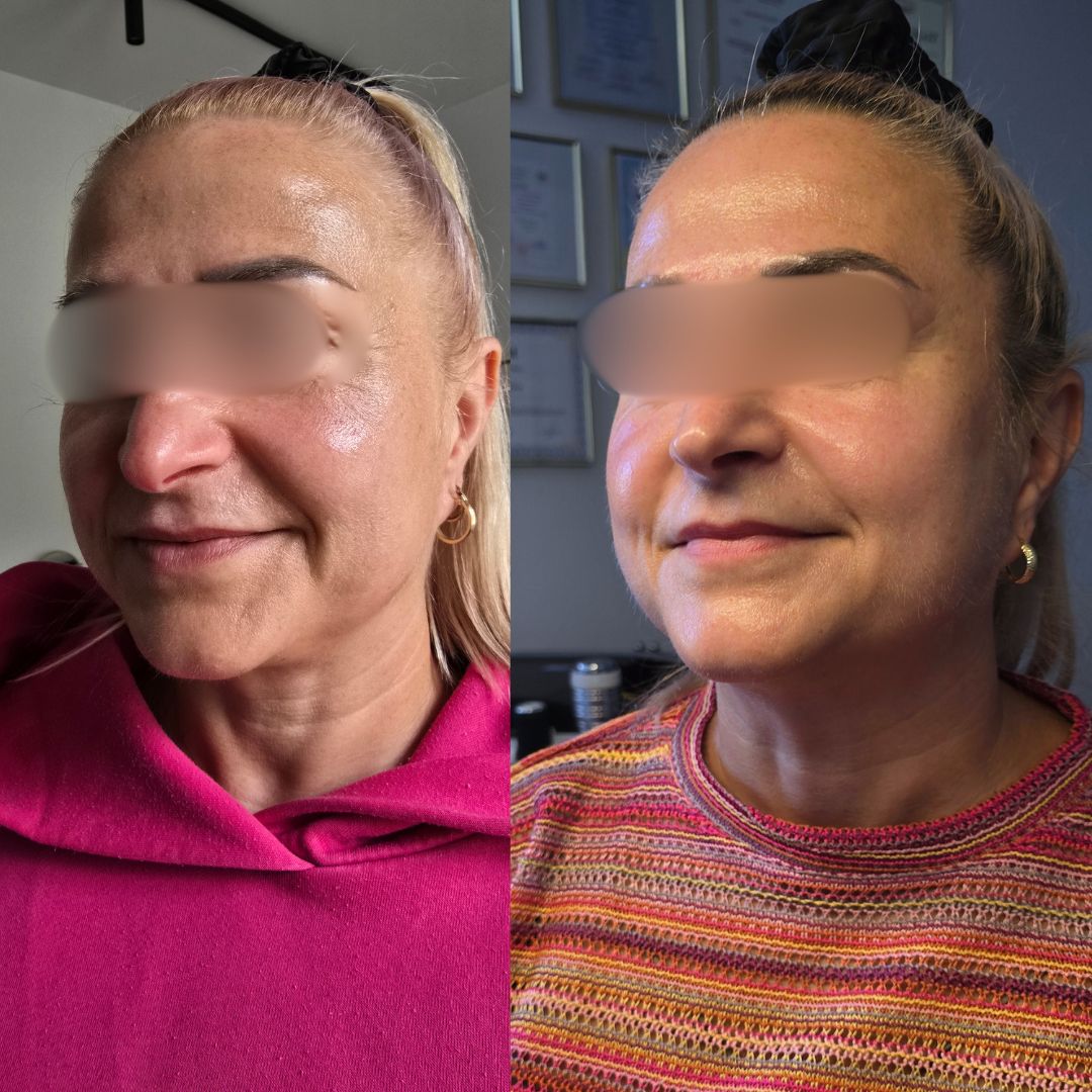 Neurolifting przed i po — ujęcie skośne, wyraźnie podniesiony owal i gęstsza skóra