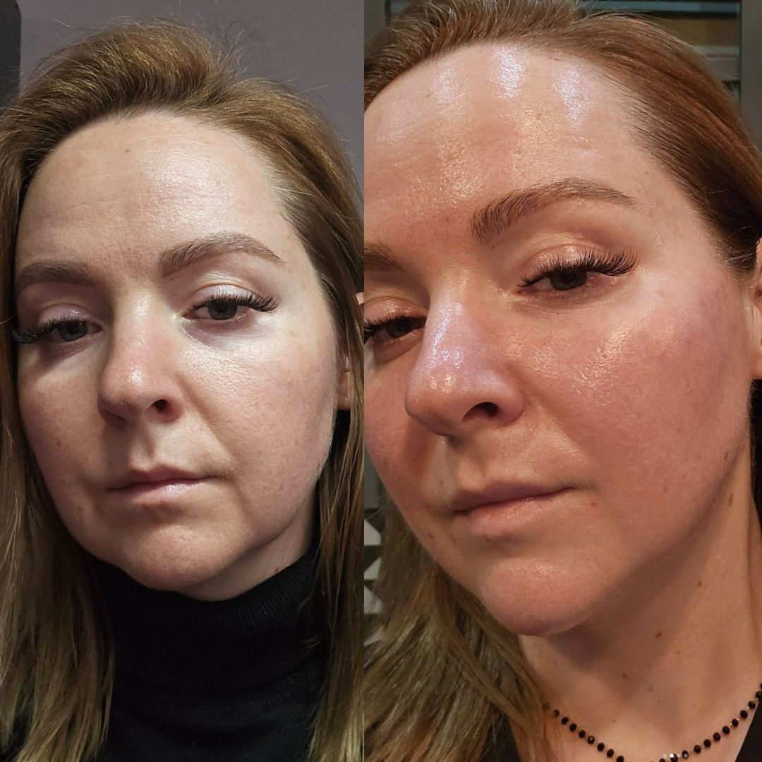Neurolifting przed i po — profil twarzy, otwarte spojrzenie i poprawiony owal