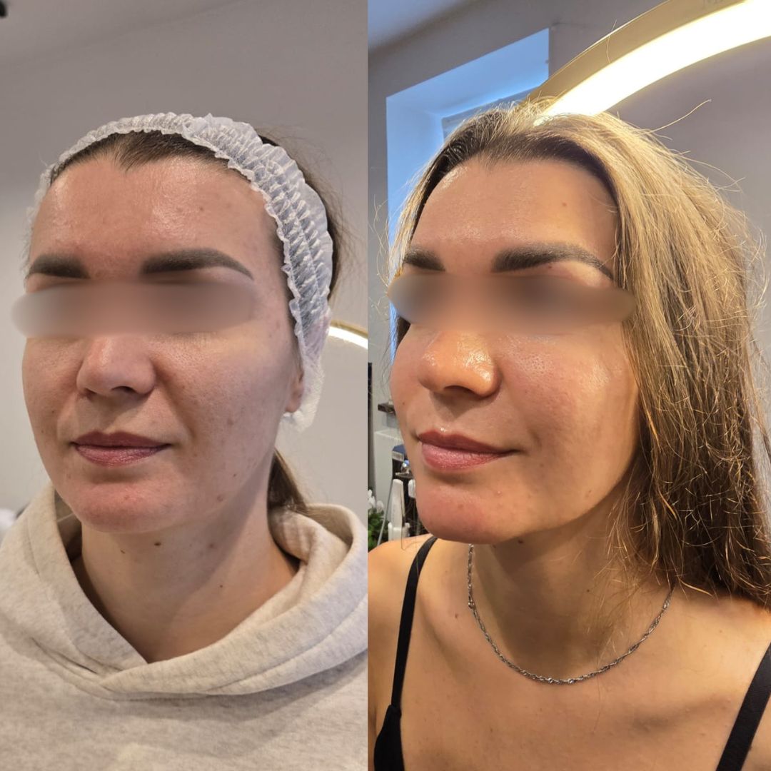 Neurolifting przed i po — detal okolicy bruzd nosowo-wargowych, mniejszy rumień i napięcie