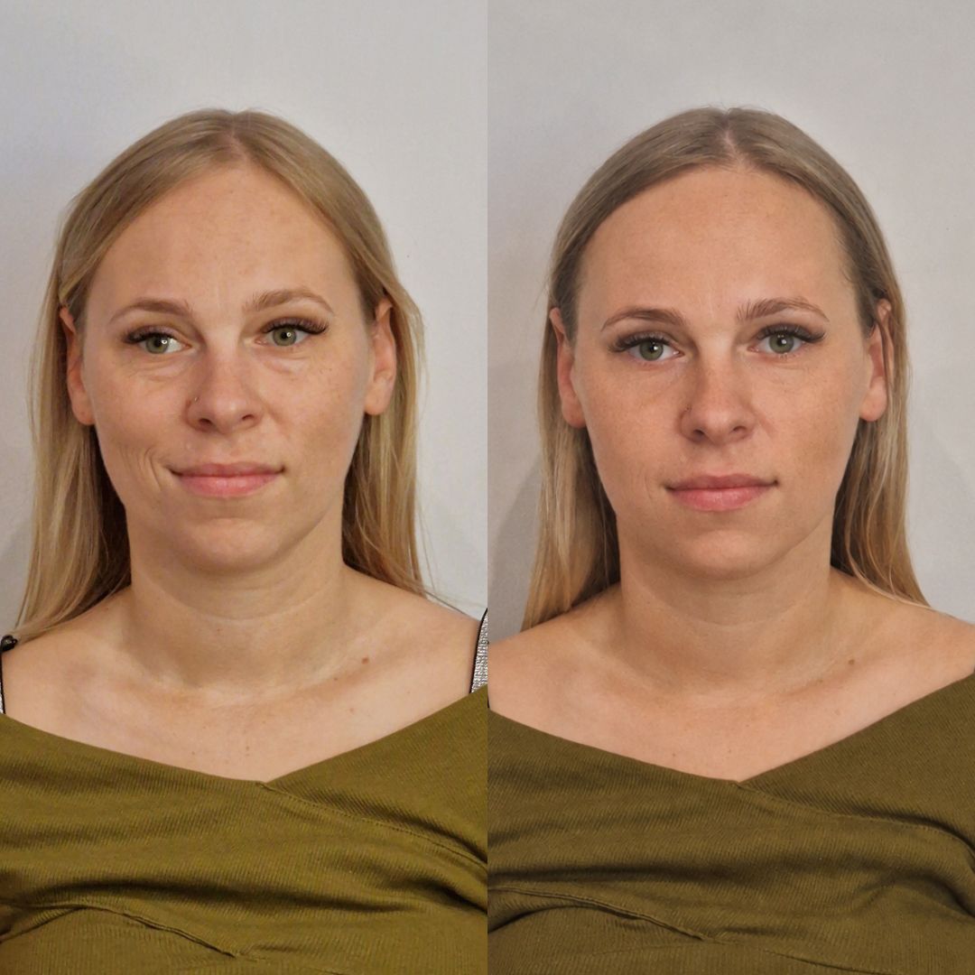 Neurolifting przed i po — ujęcie na wprost, bardziej wypoczęty wygląd twarzy